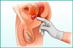 Palpace prostaty