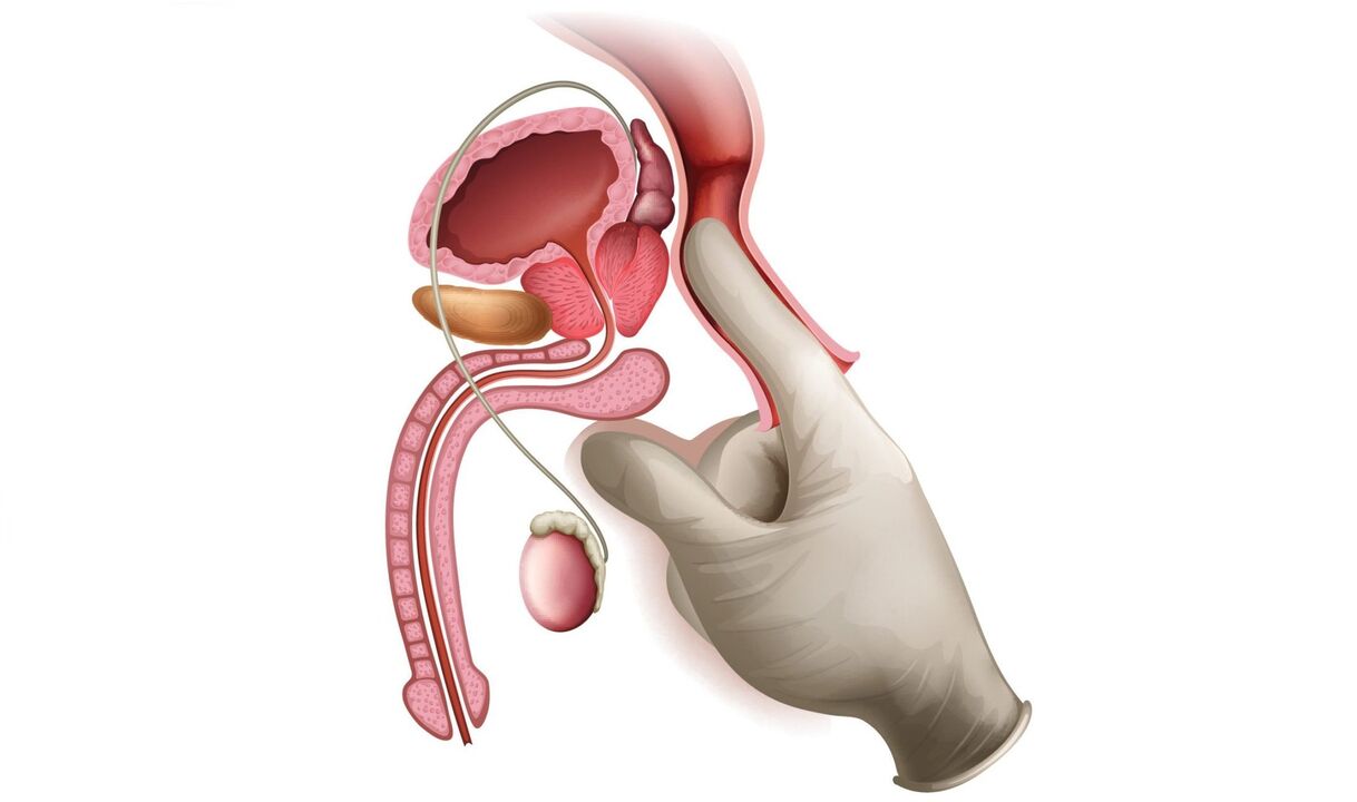 masáž prostaty pro prostatitidu